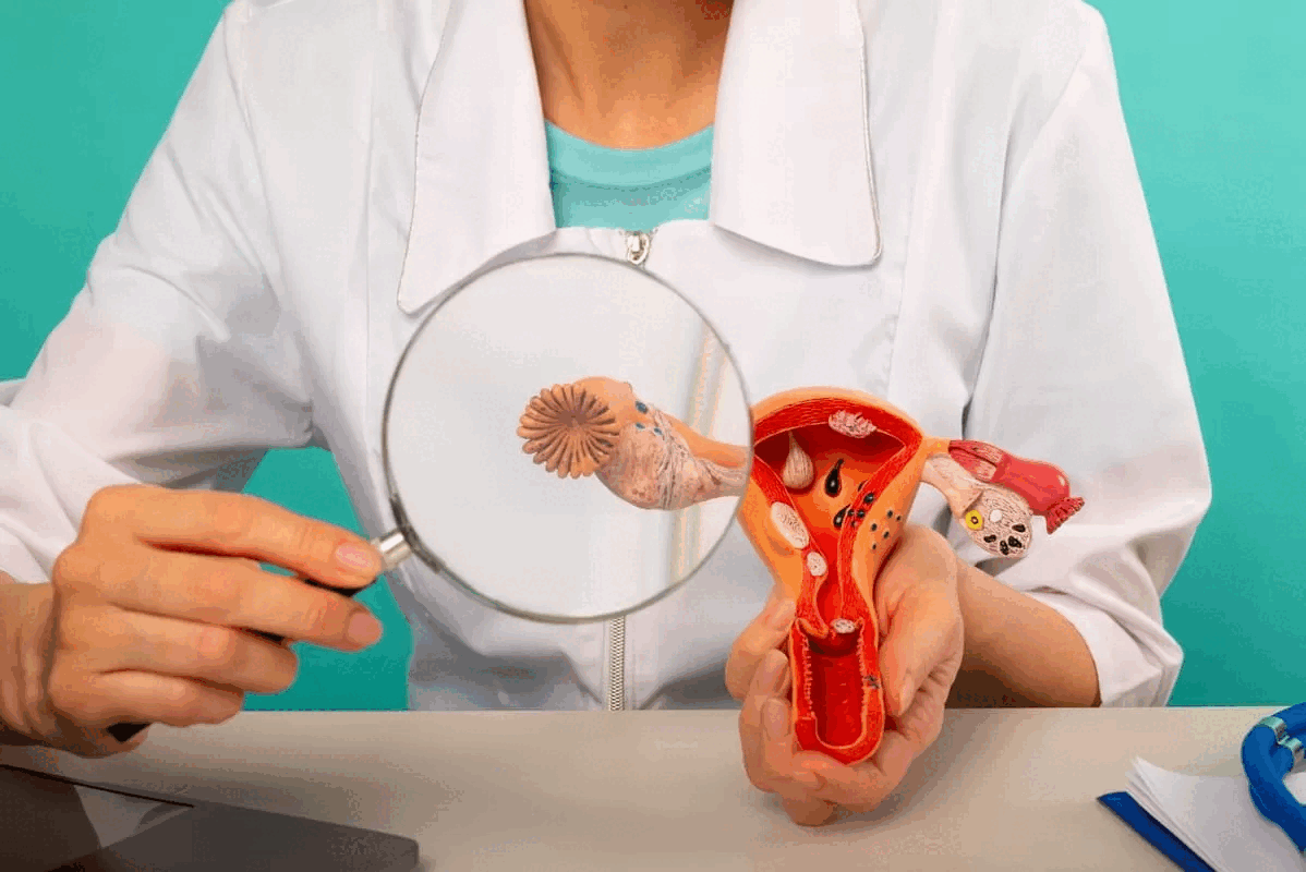 TRATAMIENTO Y MANEJO DEL CANCER DE OVARIO