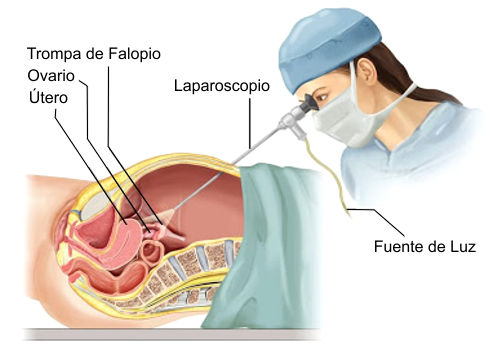 LAPAROSCOPIA GINECOLÓGICA