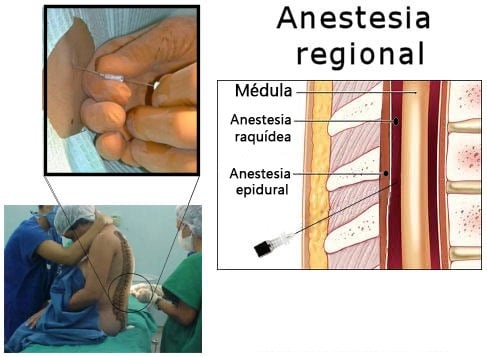 ANESTESIA REGIONAL