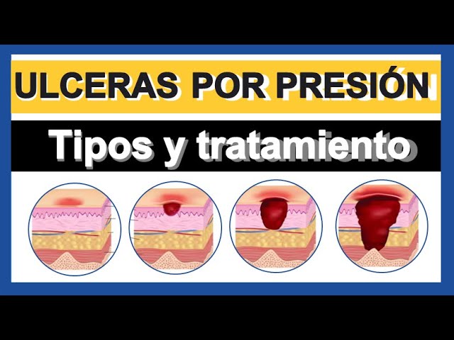 ATENCIÓN DE HERIDAS Y ÚLCERA POR PRESIÓN