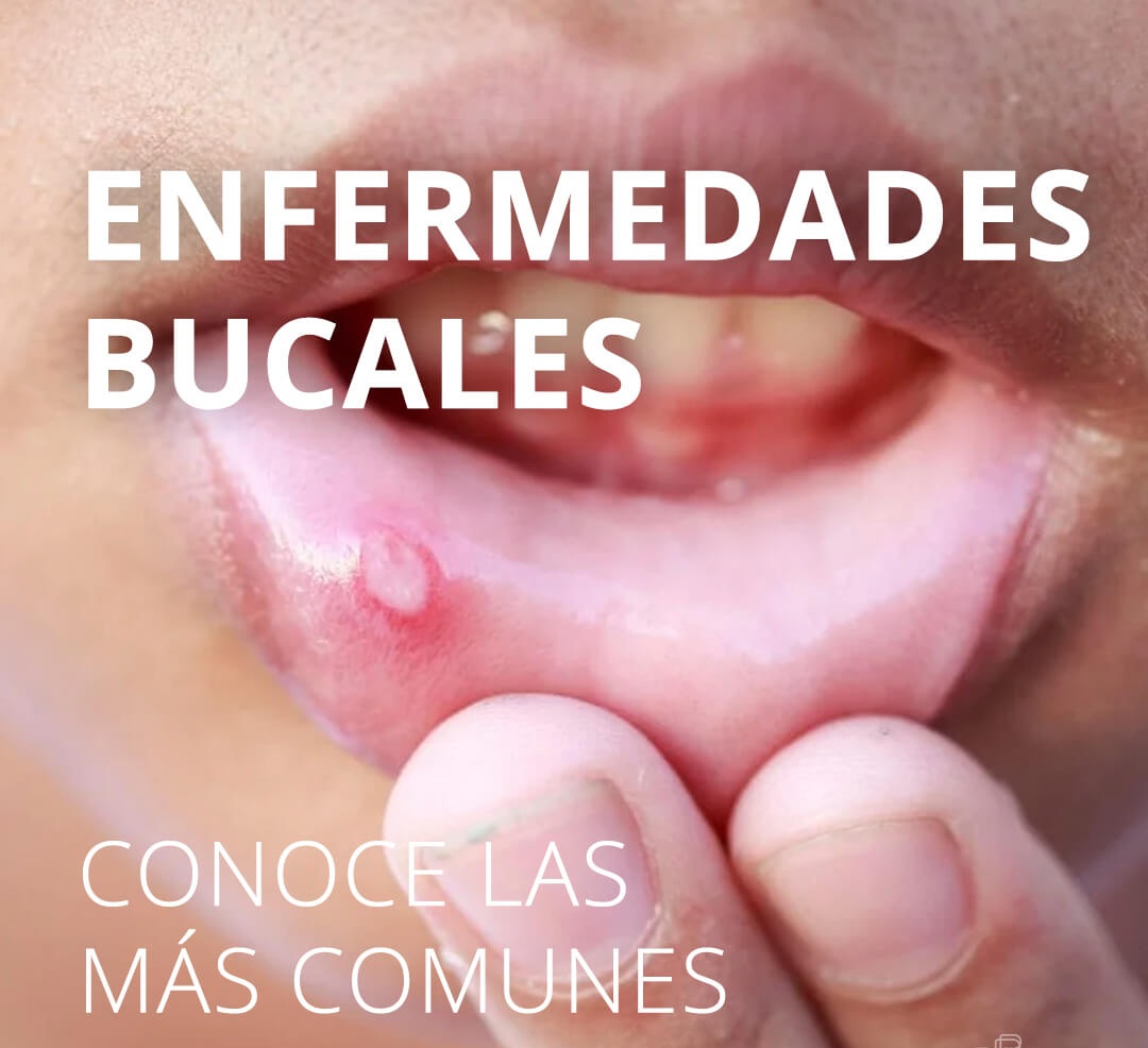 ENFERMEDADES BUCALES