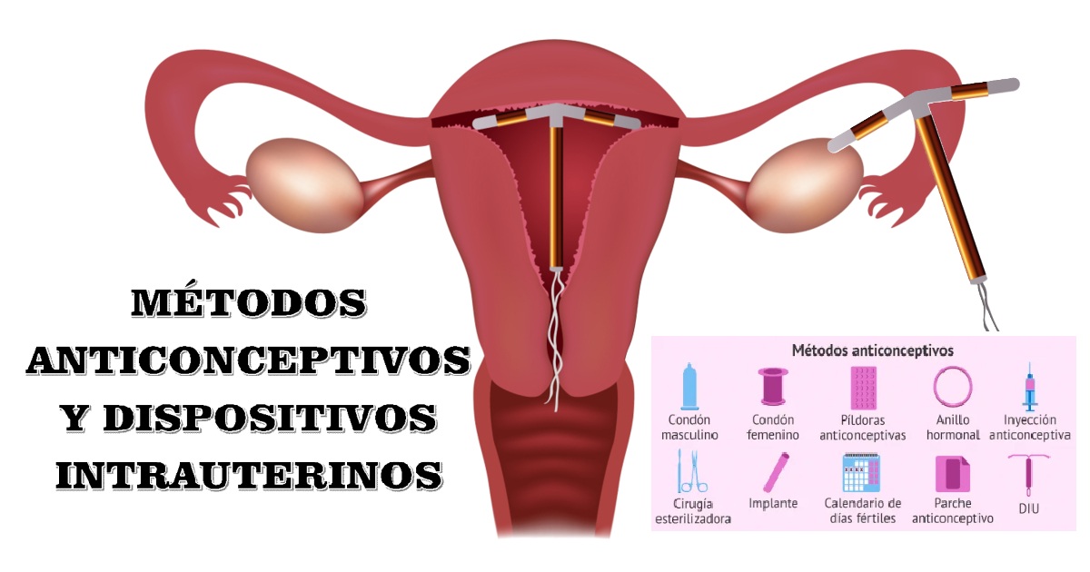 MÉTODOS ANTICONCEPTIVOS Y DISPOSITIVOS INTRAUTERINOS